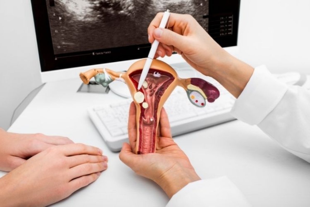 Mioma uterino lidera causas de afastamento no trabalho em 2023