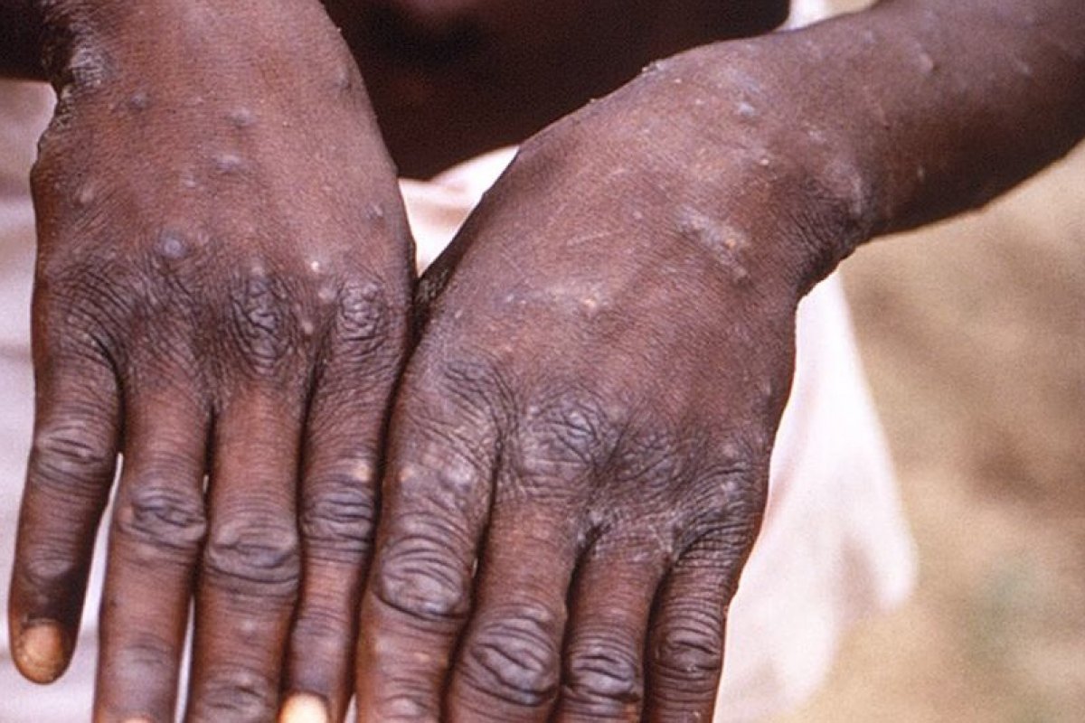 OMS faz alerta para alta de casos de Varíola M no Pacífico Ocidental