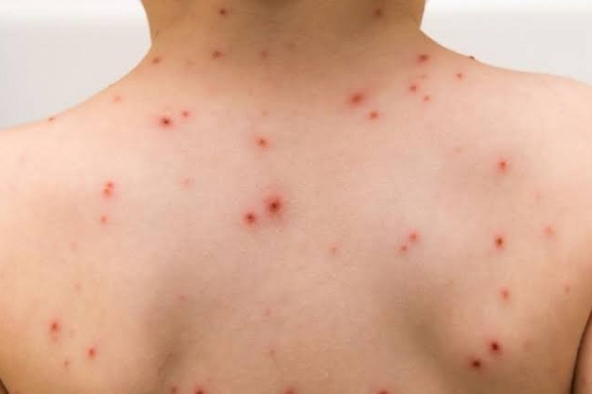 Surto de catapora na Bahia é atribuído a baixa cobertura vacinal pelo Conselho Estadual de Saúde