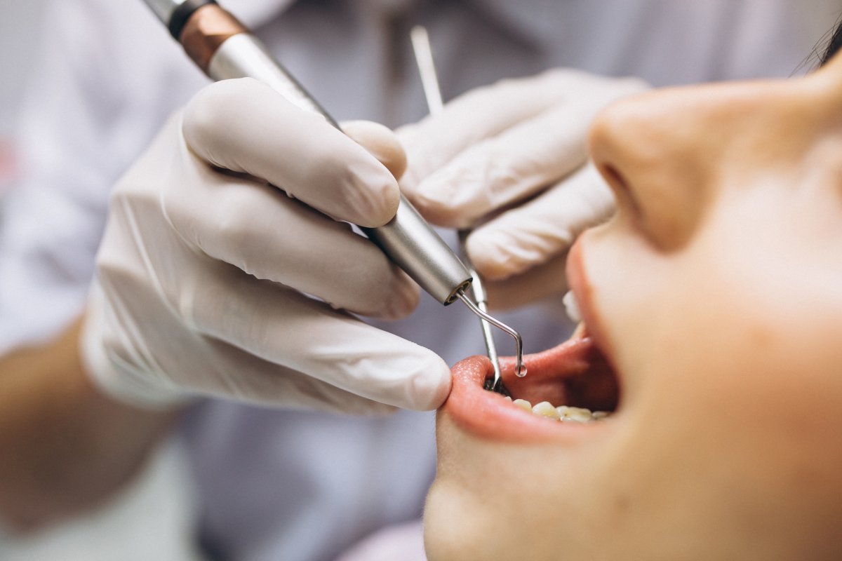 Cirurgia de retirada do siso exige cuidados redobrados: Dentista dá recomendações para evitar problemas no pós-operatório!
