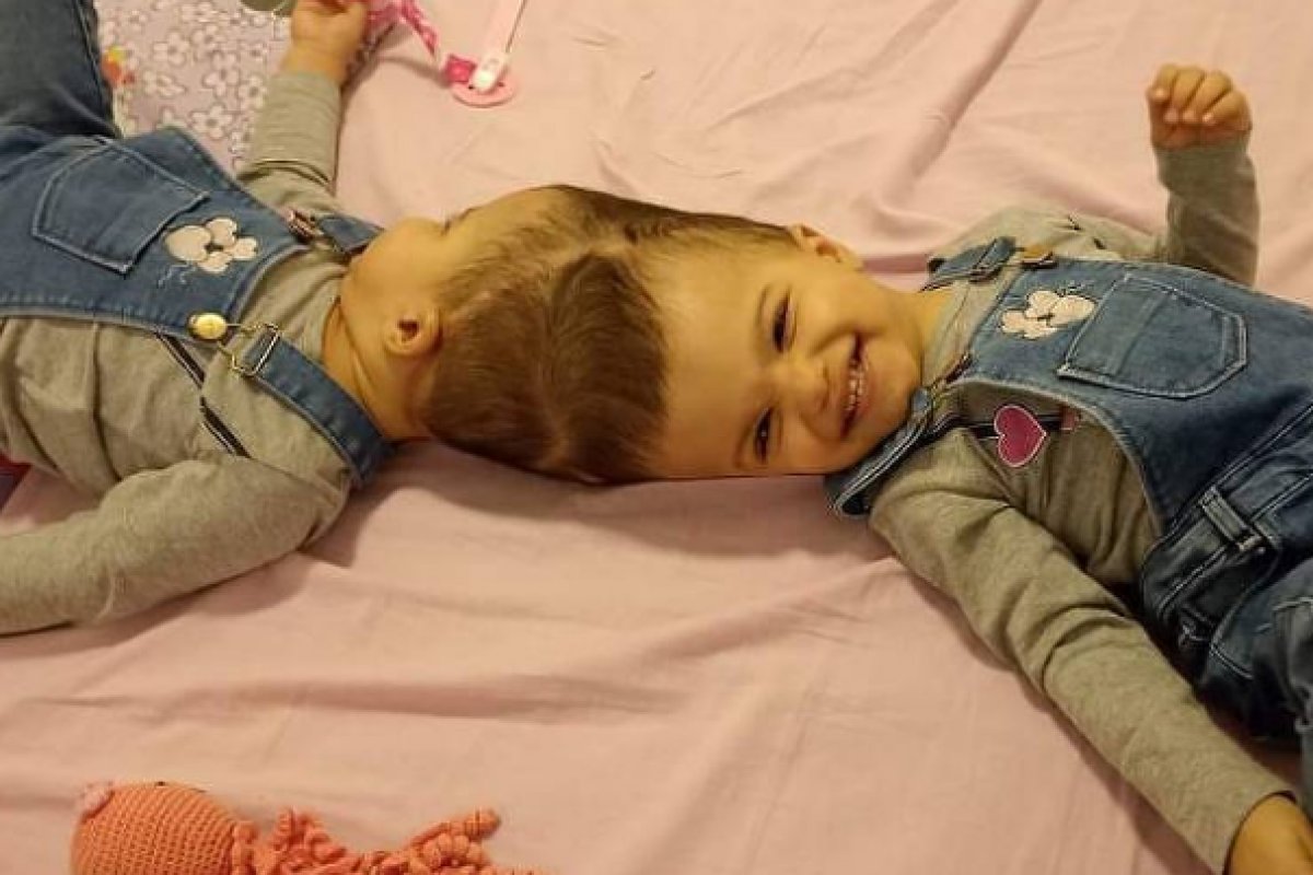 Gêmeas unidas pela cabeça são separadas após 1 ano e 4 internvenções cirúrgicas