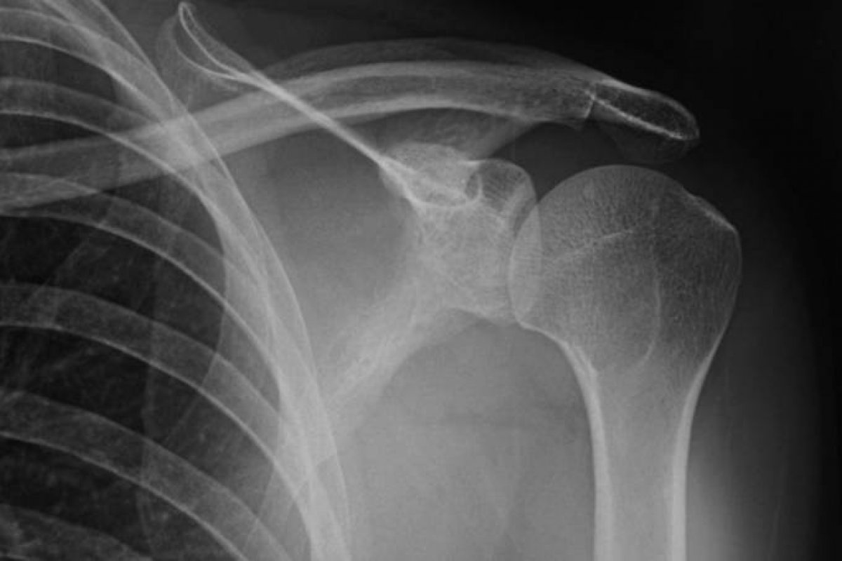 Pesquisadores da Unicamp produzem material que auxilia na regeneração de ossos