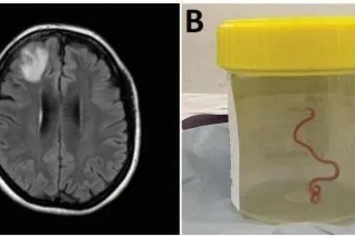 Verme comum em cobras píton é encontrado no cérebro humano pela 1° vez