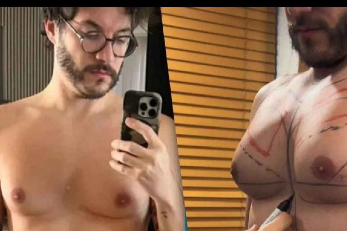 Cirurgia de ginecomastia: entenda como funciona o procedimento de redução das mamas realizado pelo ex-BBB Eliezer!