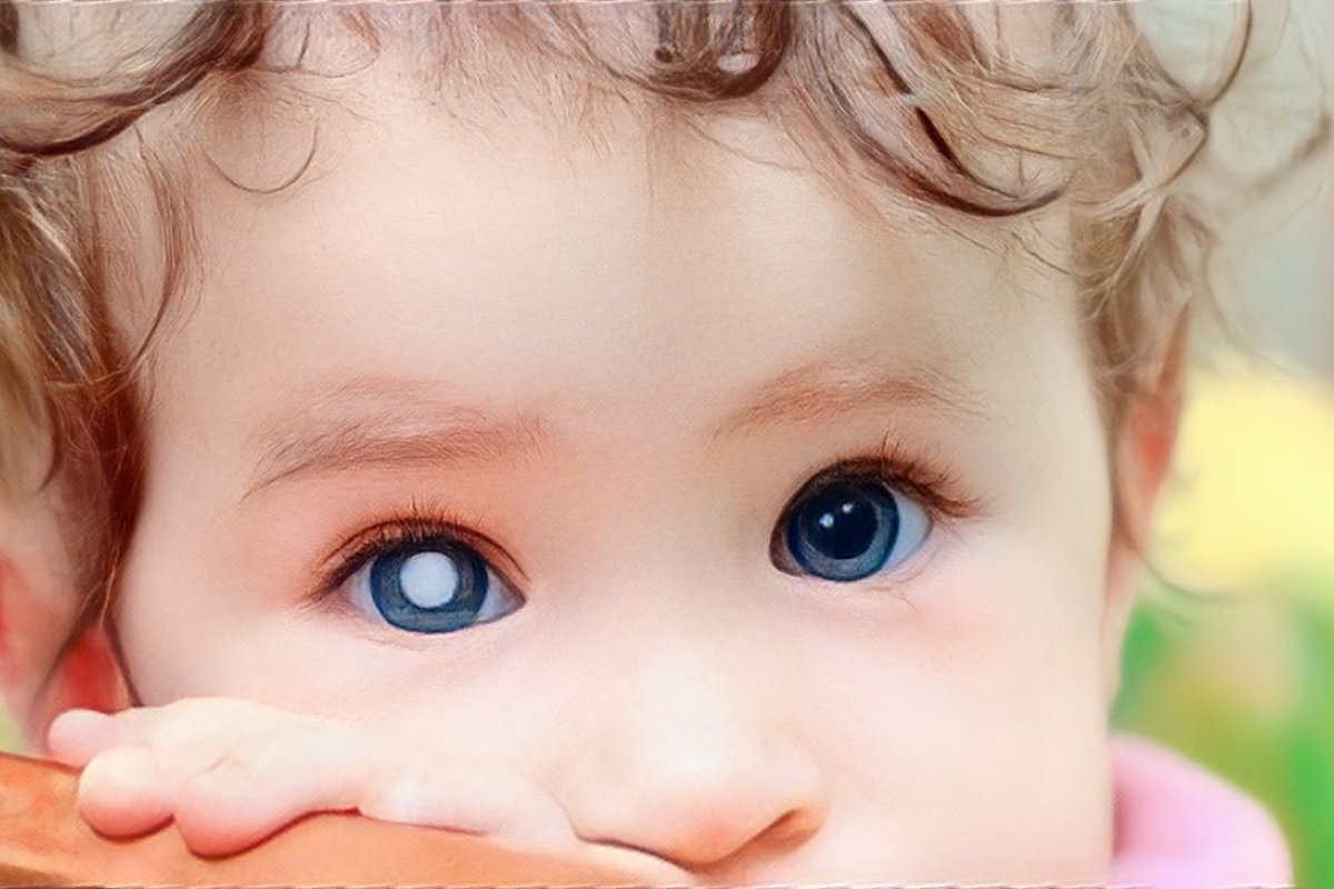 Oftalmologista faz alerta sobre o Retinoblastoma!