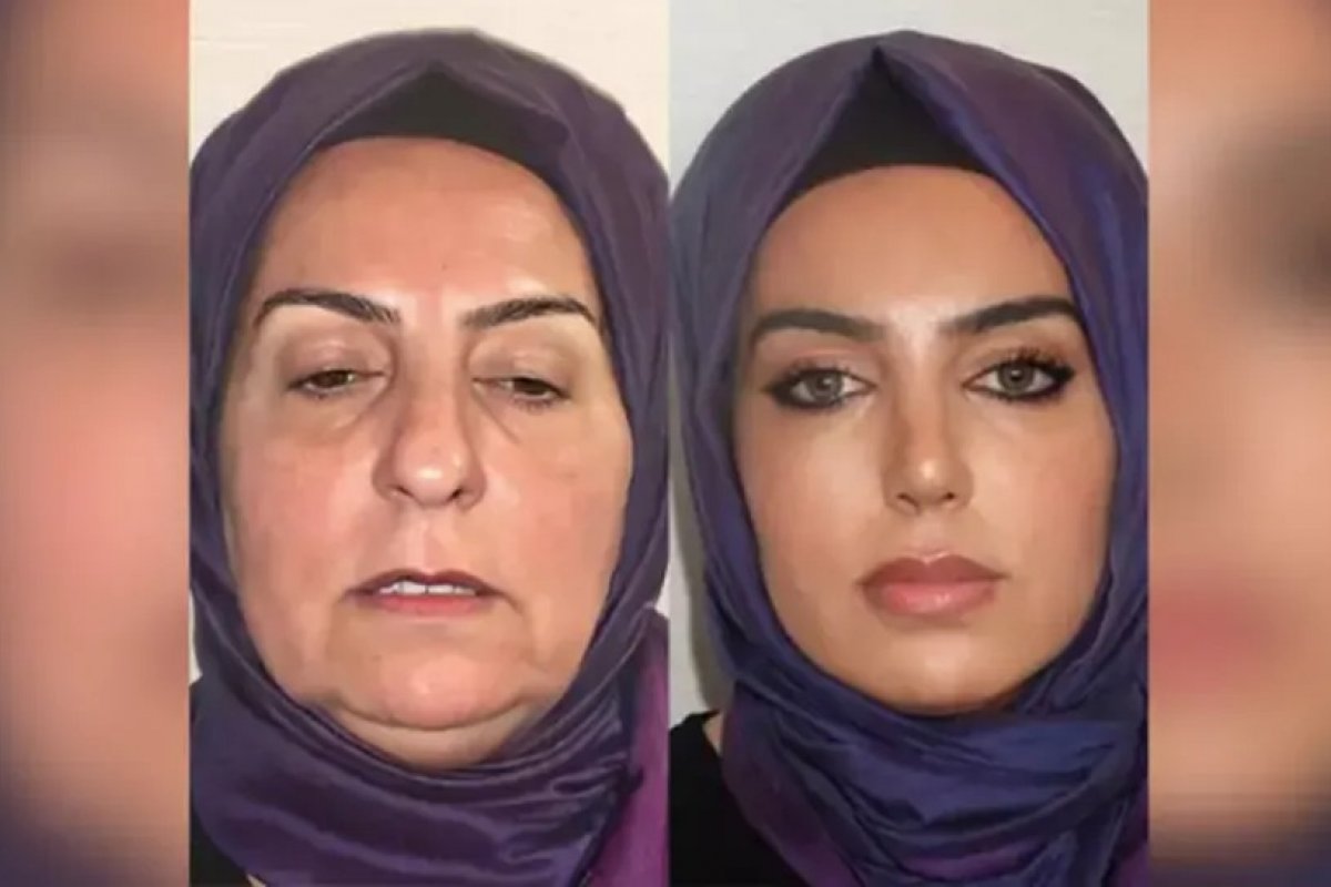 Médico turco choca a internet ao mostrar o resultado de cirurgias plásticas em paciente idosa
