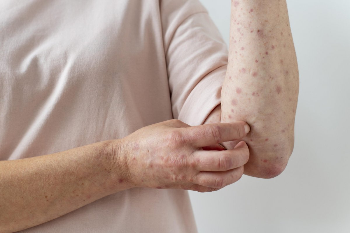 Estado faz bloqueio vacinal após caso de catapora em maternidade em Salvador