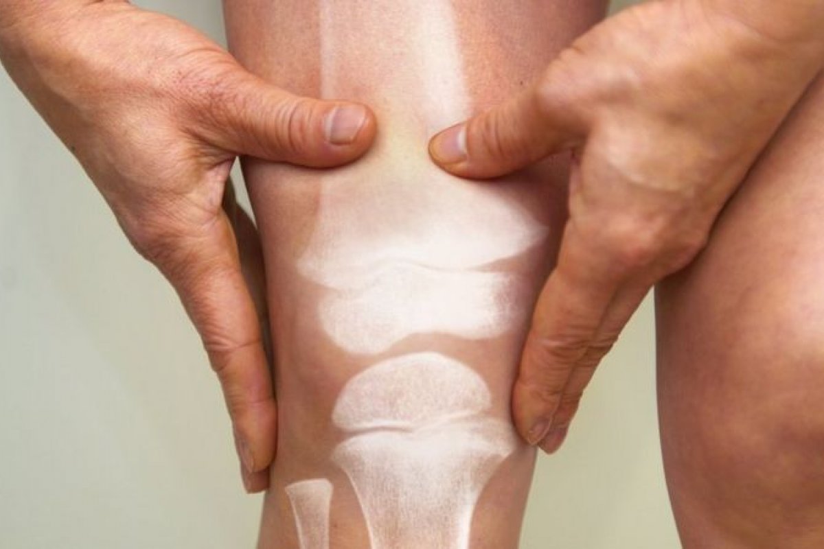 Osteoporose nos homens pode levar a complicações mais graves devido ao diagnóstico tardio