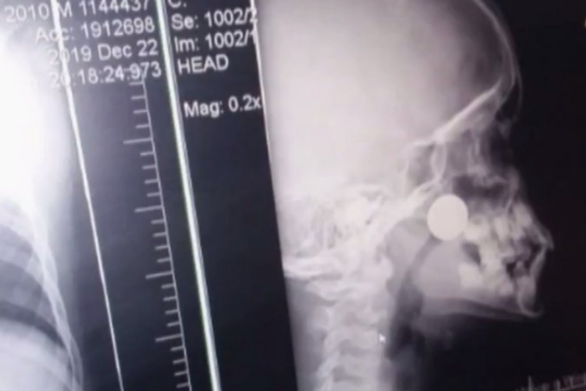 Menino enfia moeda em nariz e objeto é retirado após espirro