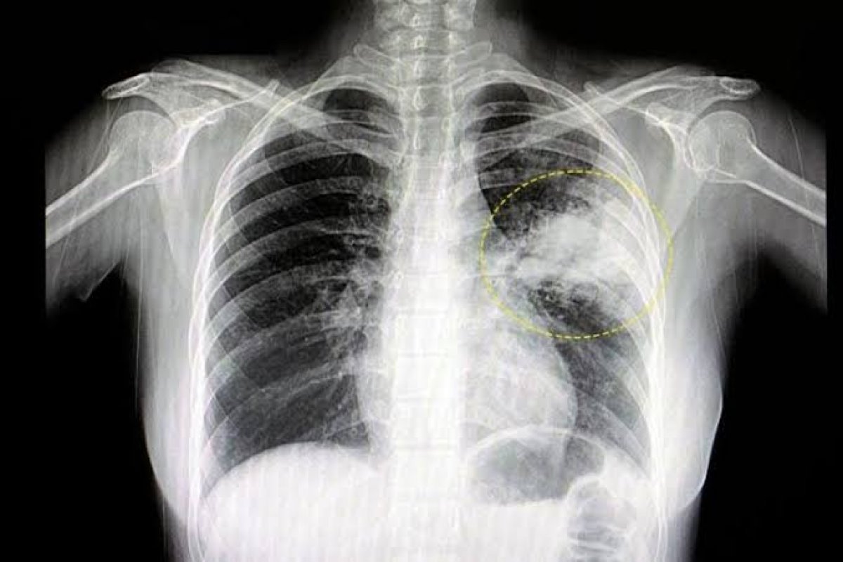 SUS registra mais de 600 mil internações anuais por pneumonia e influenza