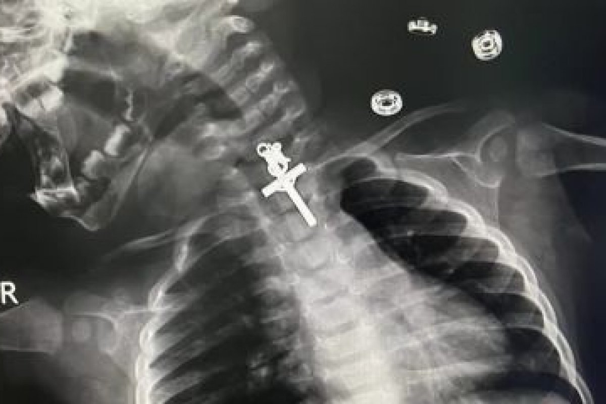 Crucifixo fica preso em garganta de bebê de 10 meses