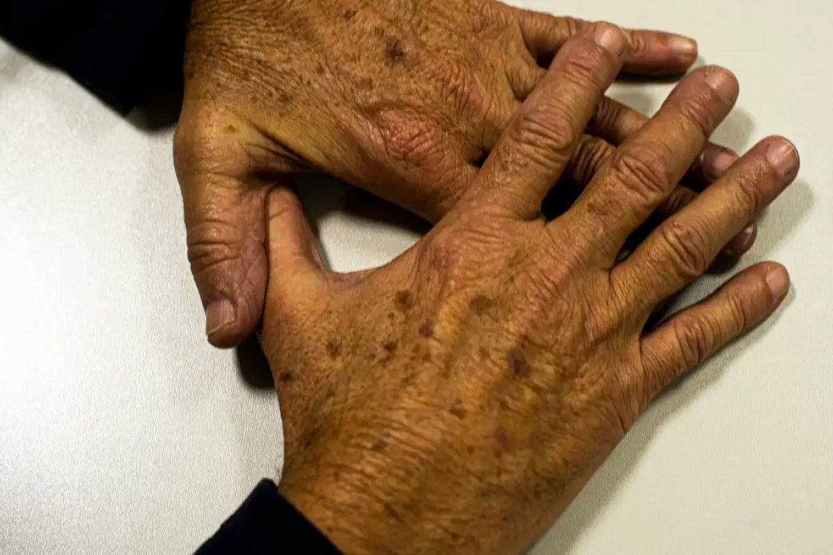 Calor extremo pode aumentar casos de problemas de pele