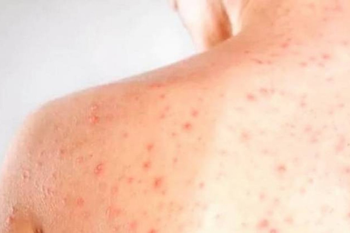 OPAS reforça que Brasil ainda não está livre do sarampo