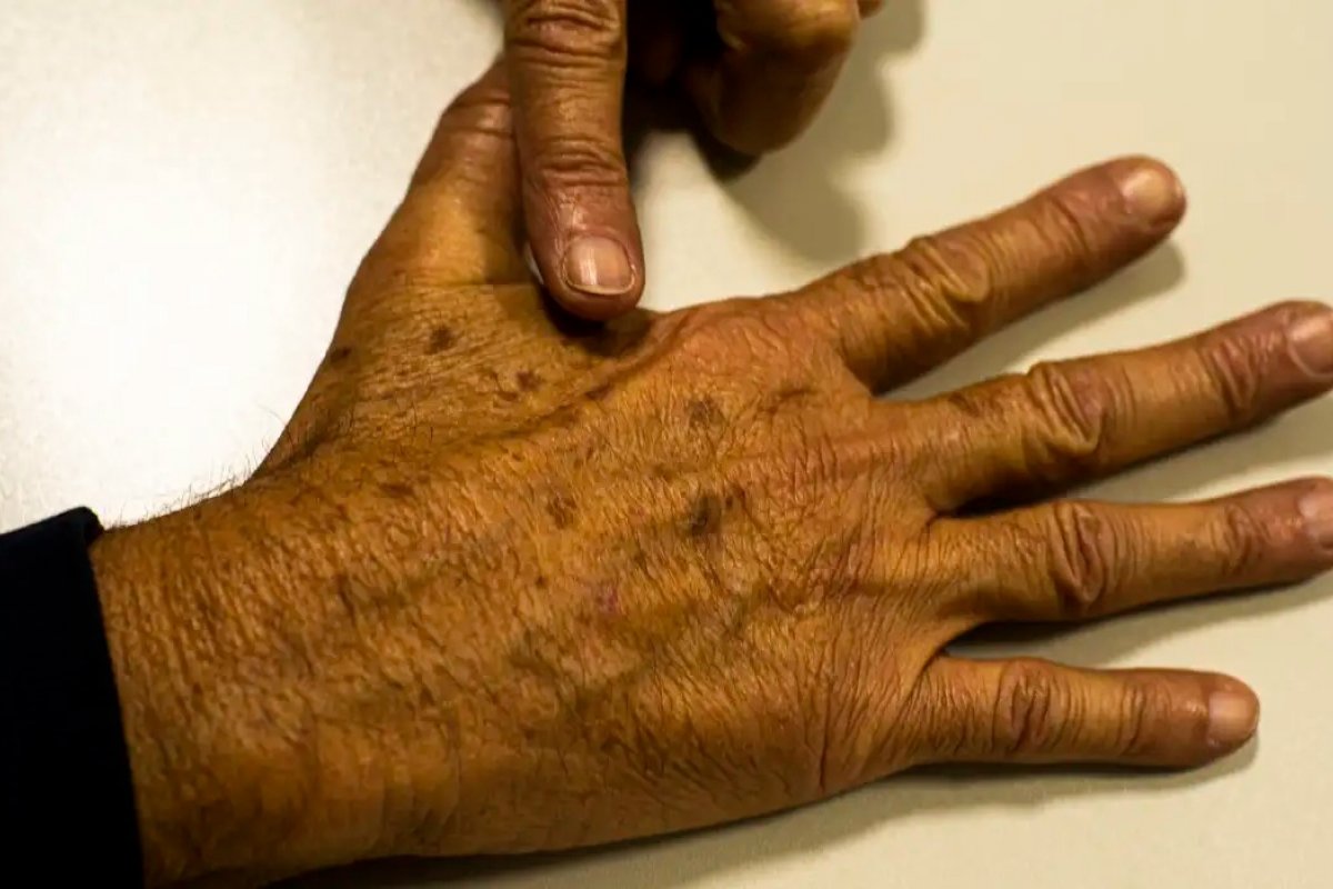 Mutirão de prevenção ao câncer de pele realizará atendimentos gratuitos na Bahia neste sábado (2)