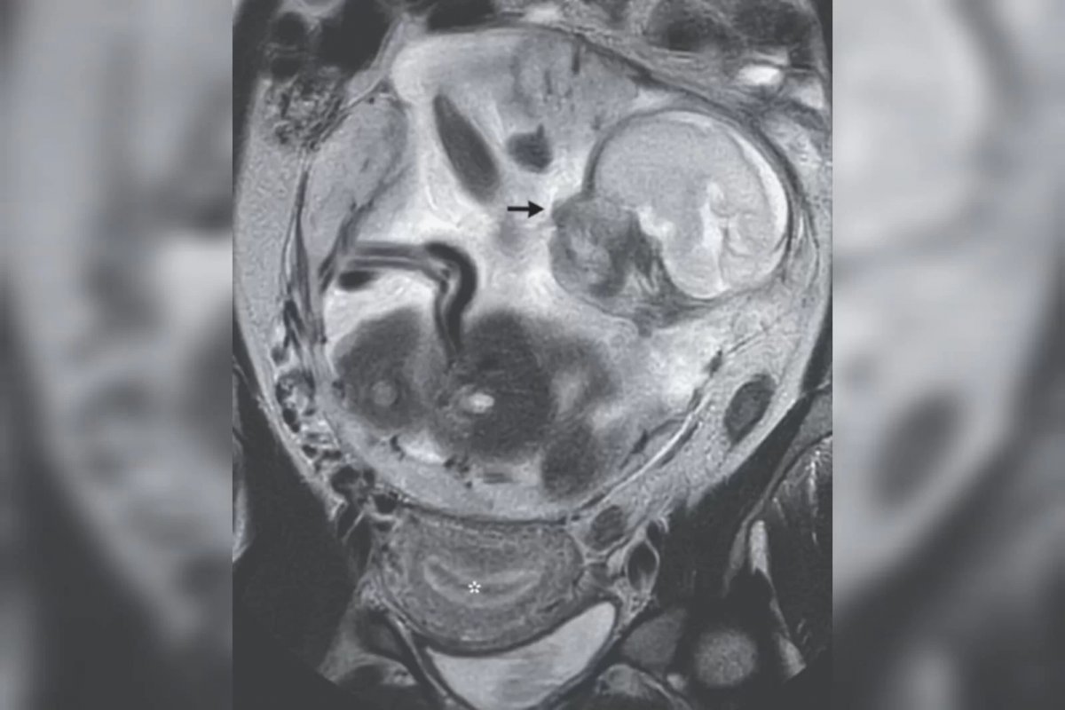 Mulher com cólicas descobre gestação de 23 semanas na França