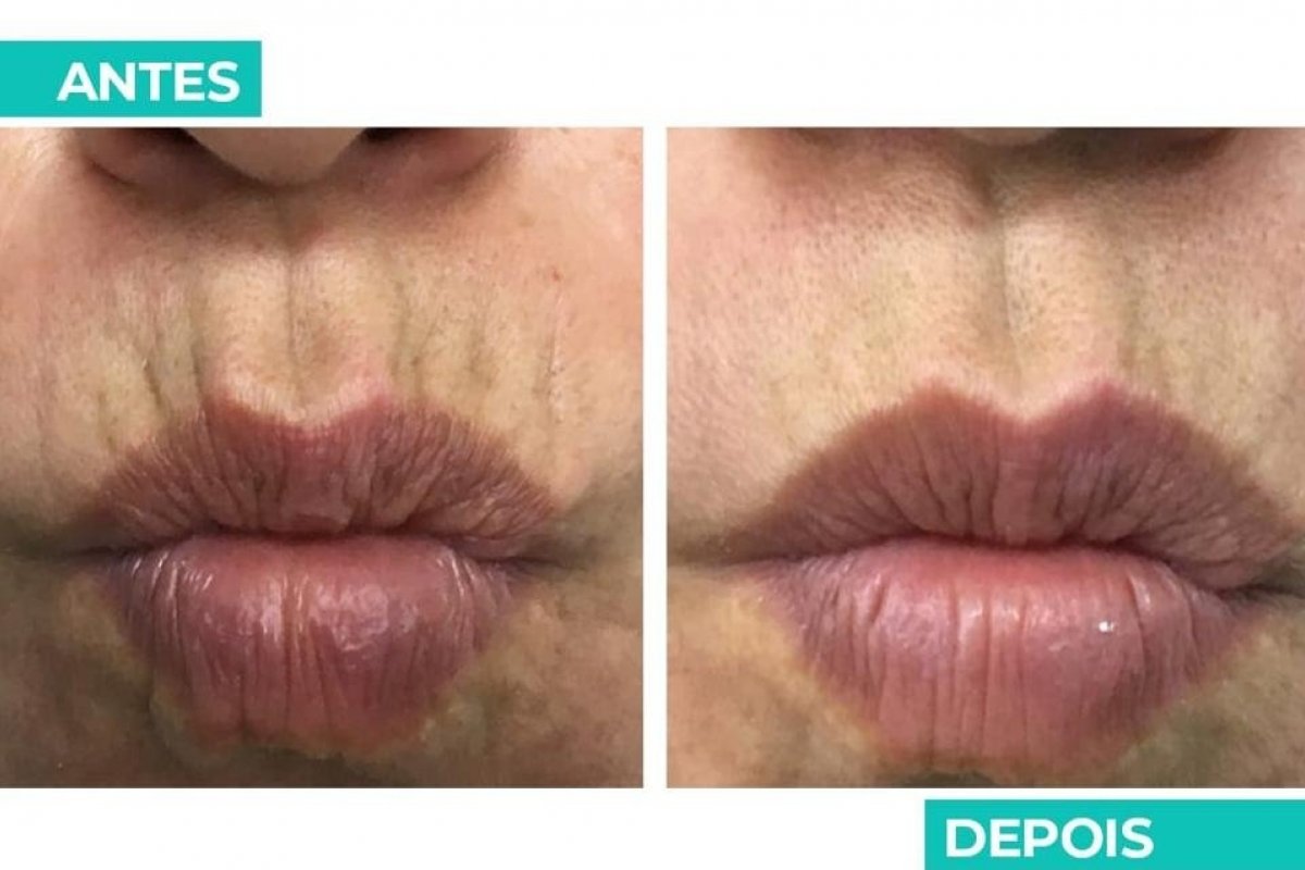 Rugas periorais: saiba como tratar o código de barras!