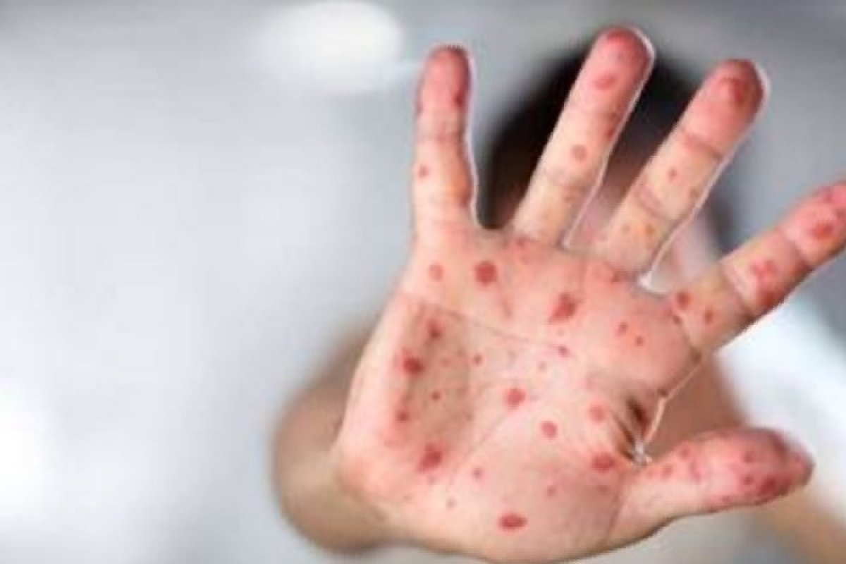 Pediatra alerta para os cuidados com a Síndrome mão-pé-boca