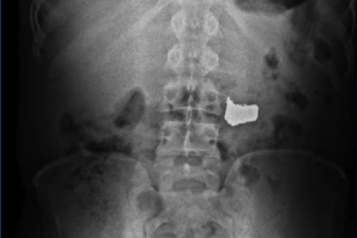 Ladrão engole corrente de ouro da vítima para tentar fugir de flagrante em Salvador