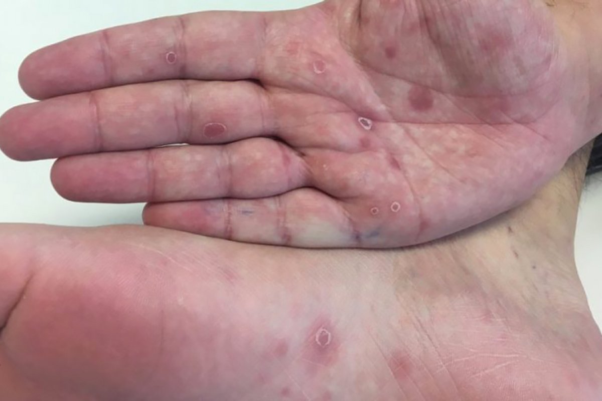 Oito perigosas doenças sexualmente transmissíveis