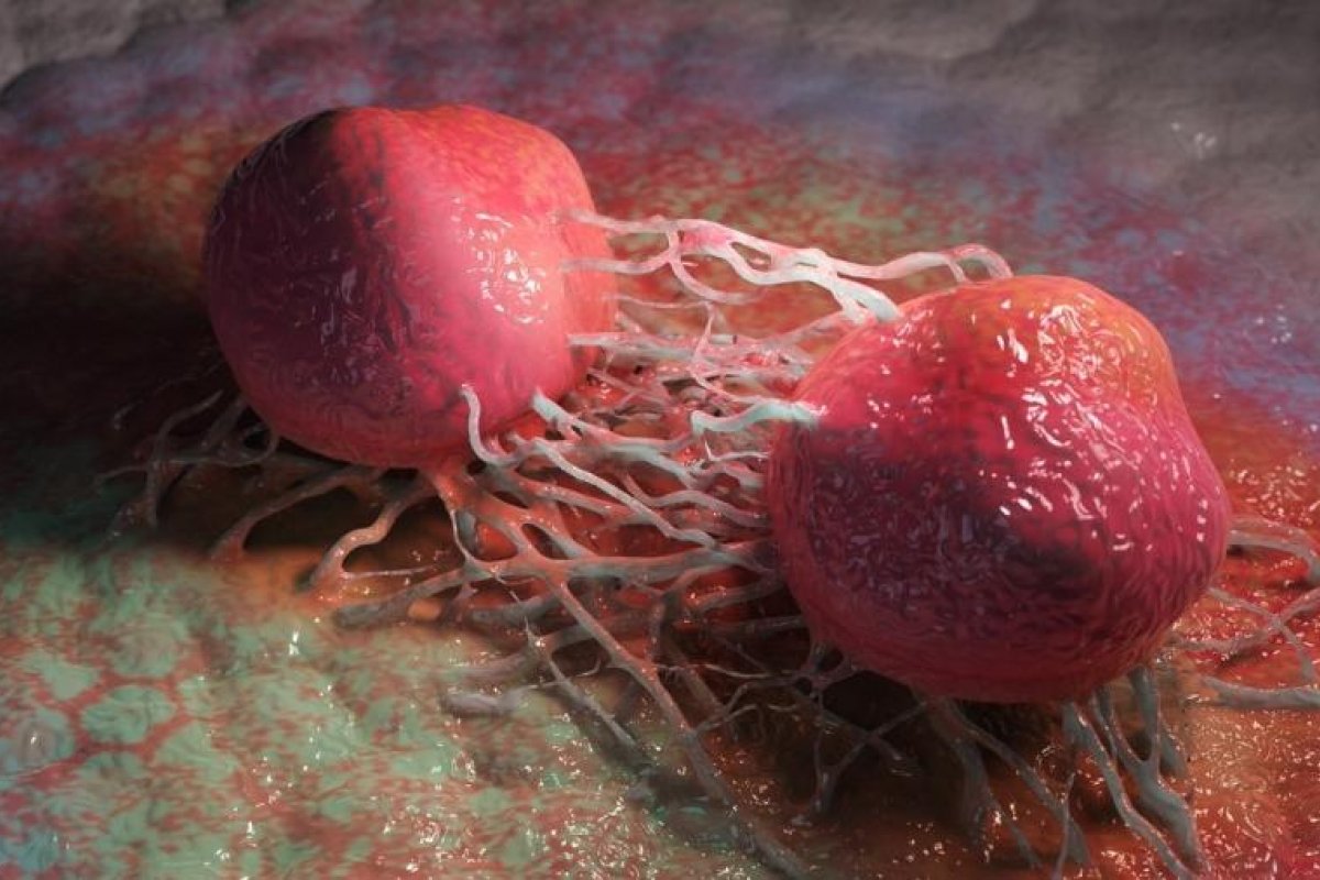 Número de novos casos de Câncer pode atingir quase 35 milhões até 2050, alerta OMS