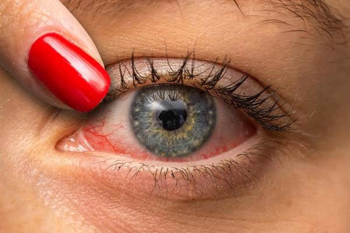 Pressão baixa aumenta risco de desenvolver glaucoma, diz estudo!