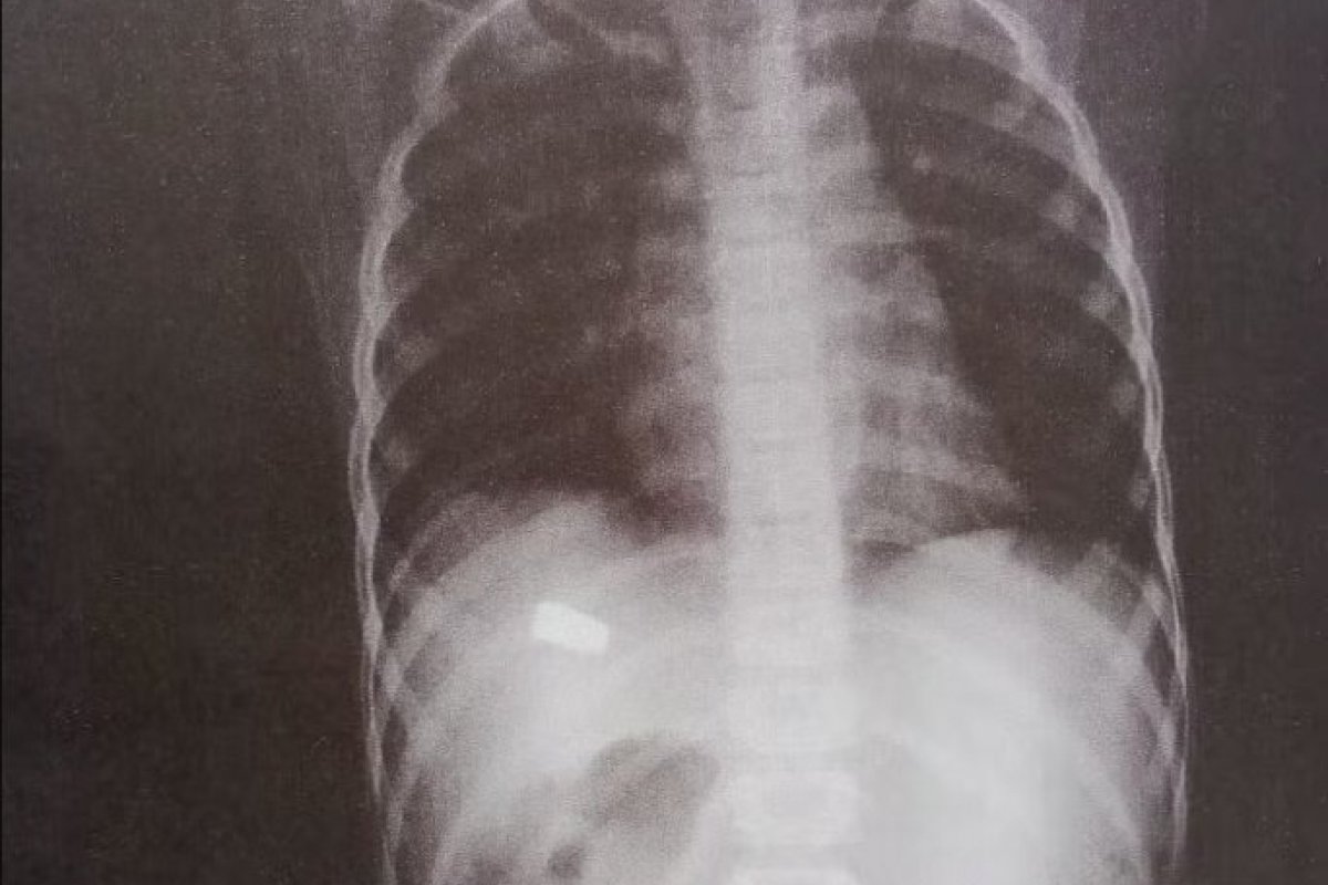 Criança de 8 anos é baleada enquanto brincava em Mussurunga, em Salvador