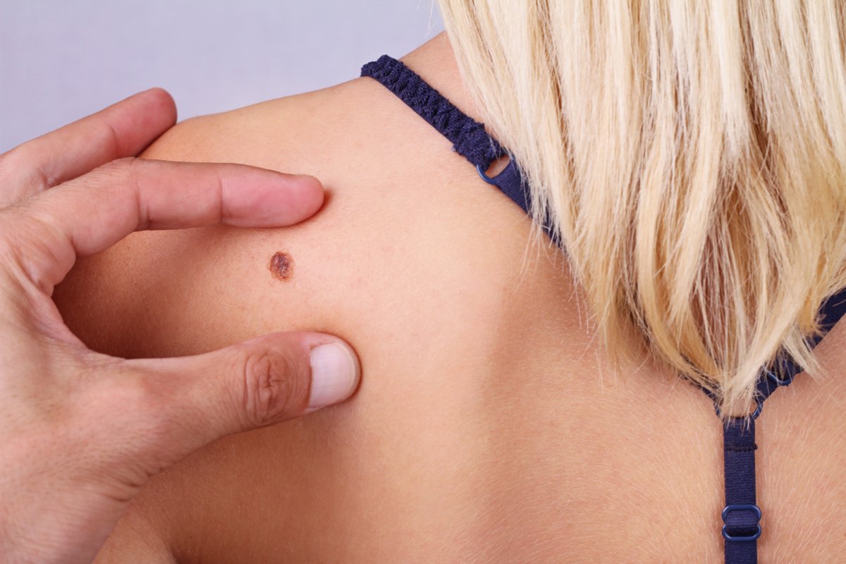 Melanoma: cuidado com sua pele