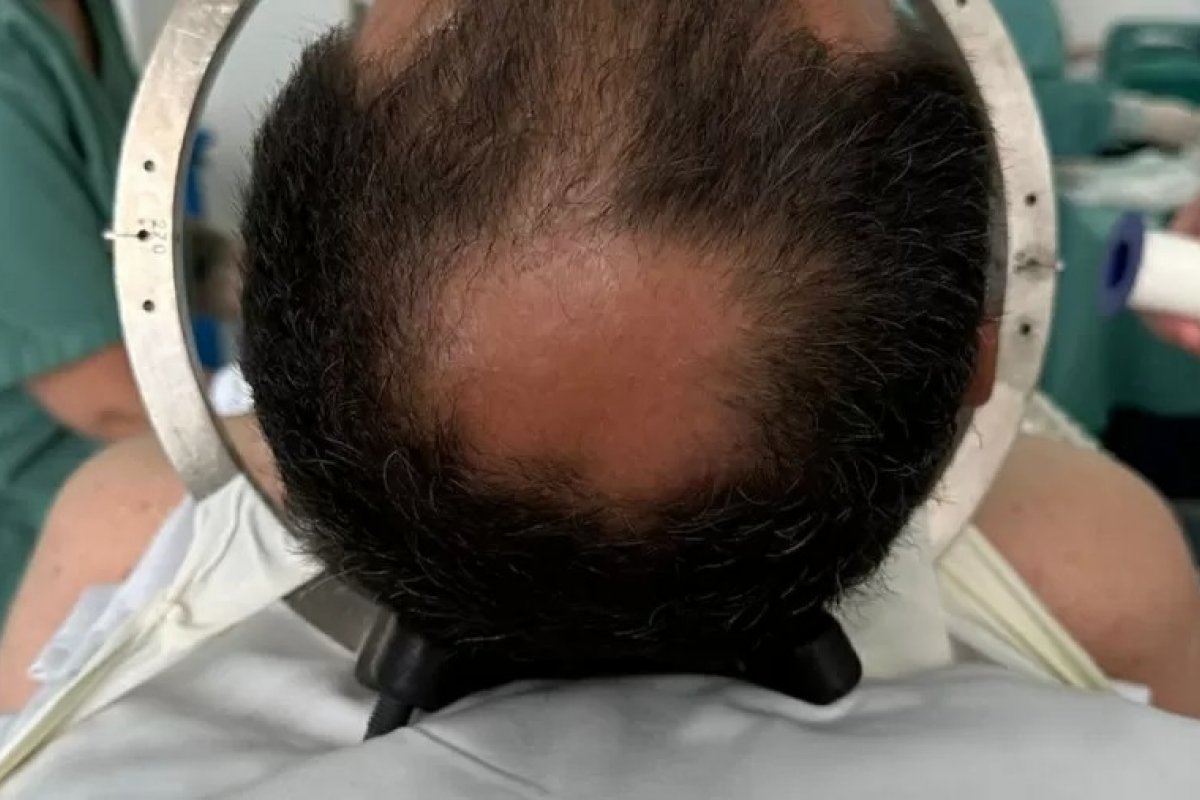 Homem trata TOC com implante cerebral inédito no Brasil