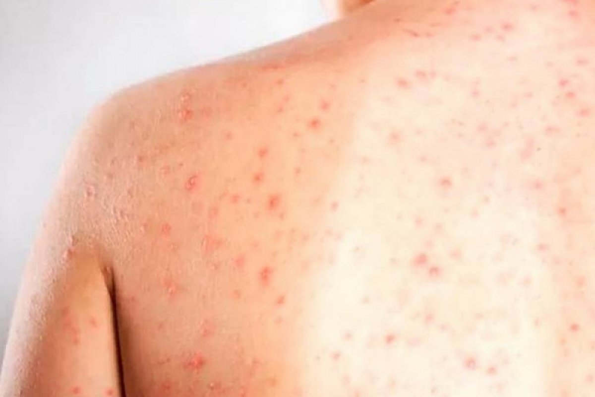 OMS alerta para aumento de casos de sarampo no mundo