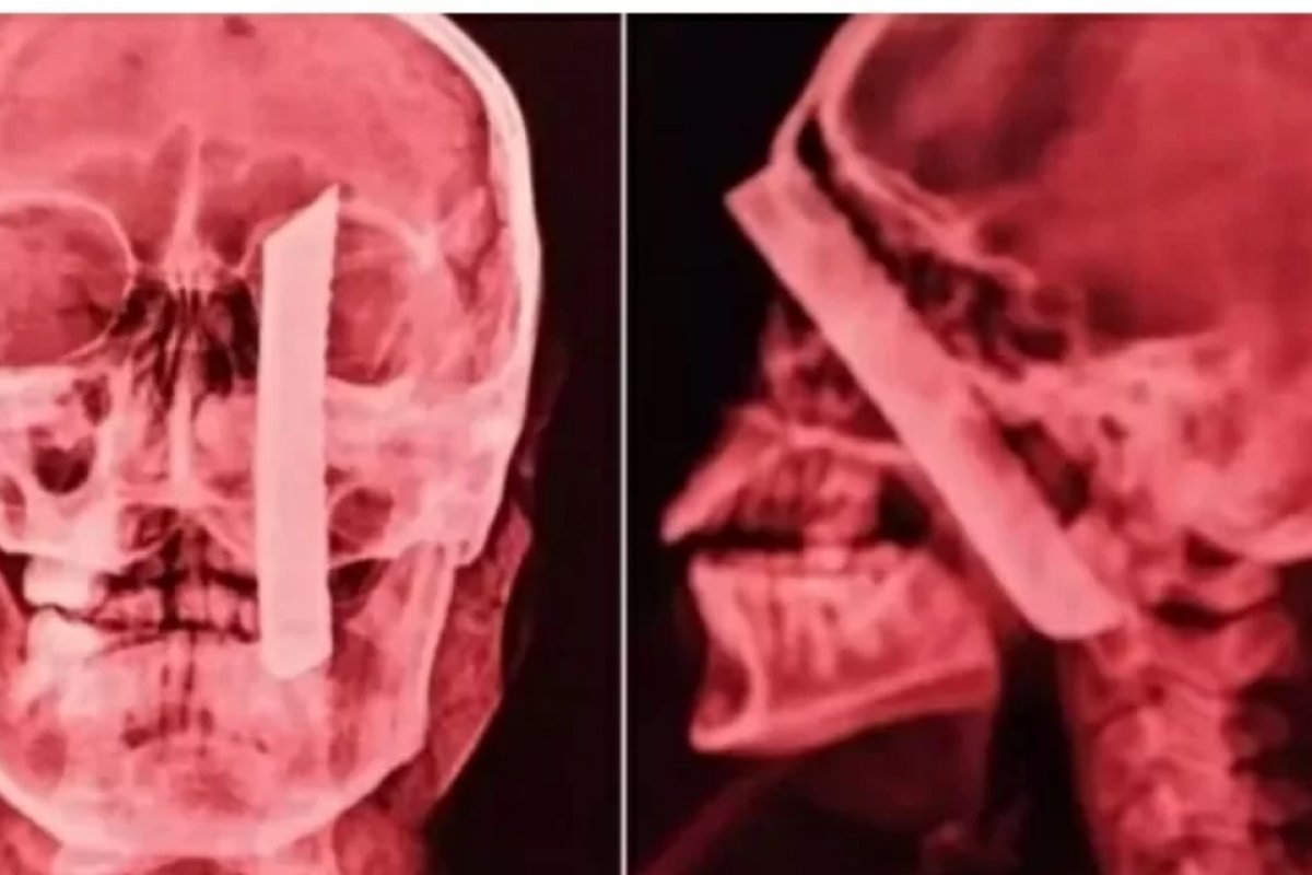 Mulher sobrevive após cirurgia para retirar lâmina de faca presa no crânio