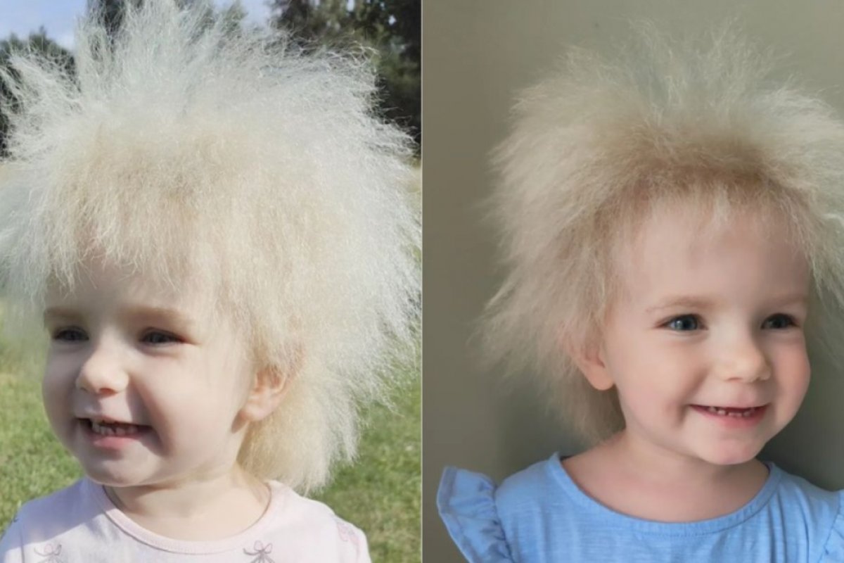 Saiba o que é síndrome do cabelo impenteável