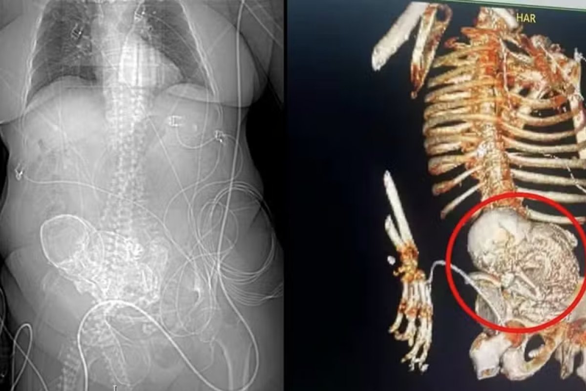 Idosa descobre feto calcificado após 50 anos e morre após cirurgia de retirada