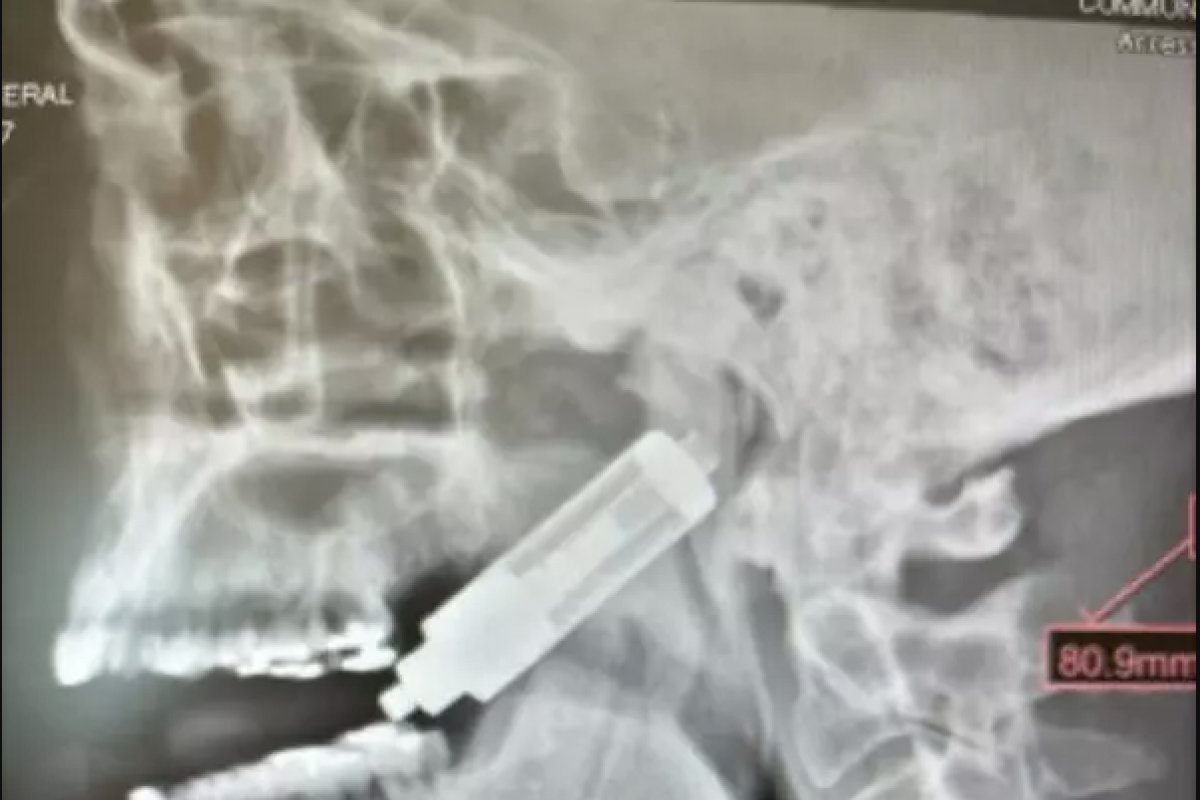 Homem fica ferido após de vape explodir e alojar no crânio