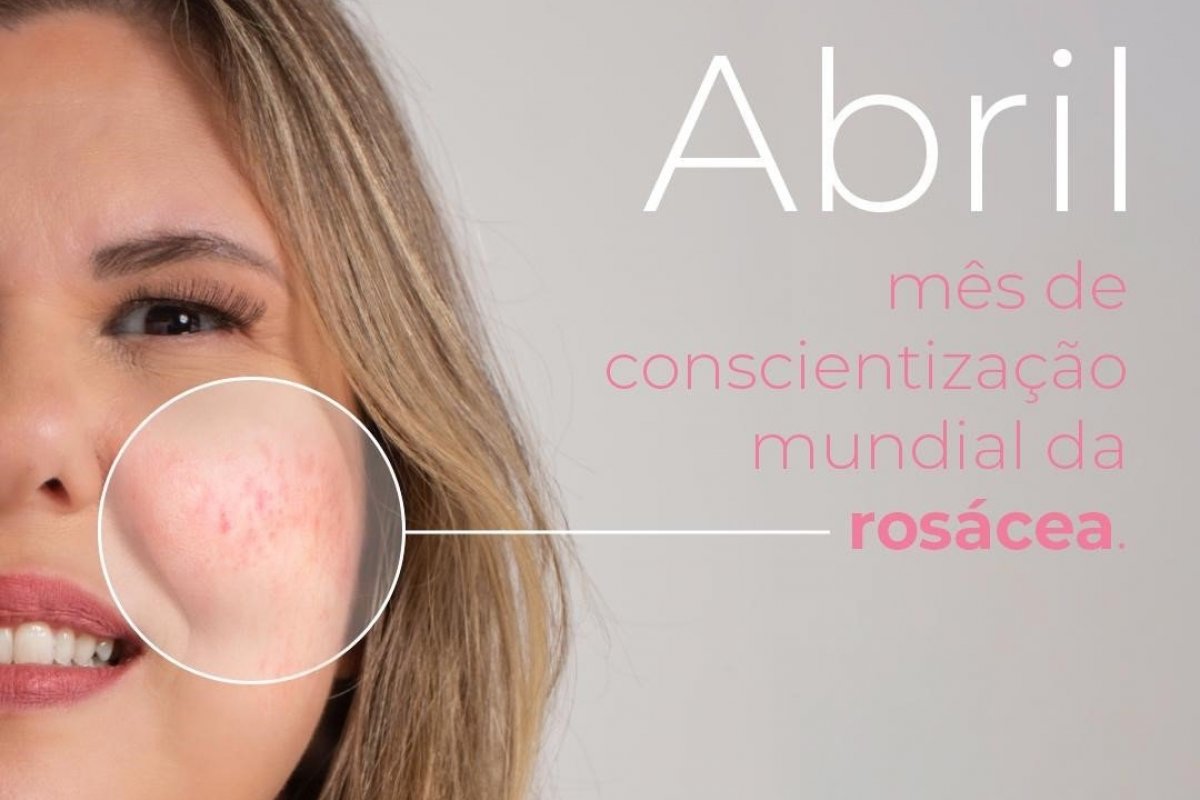 Rosácea em Foco: abril, mês mundial da conscientização!