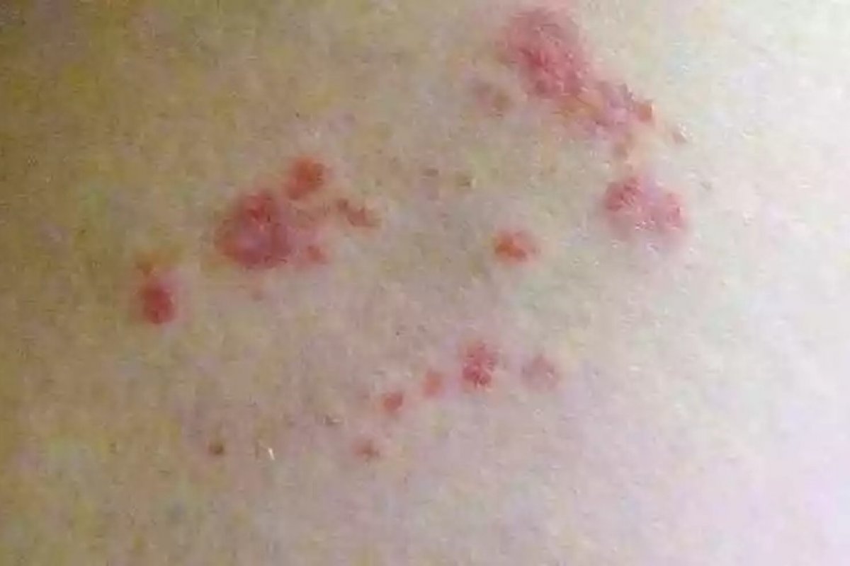 Herpes-zóster: internações por herpes-zóster crescem 31,6% no Brasil