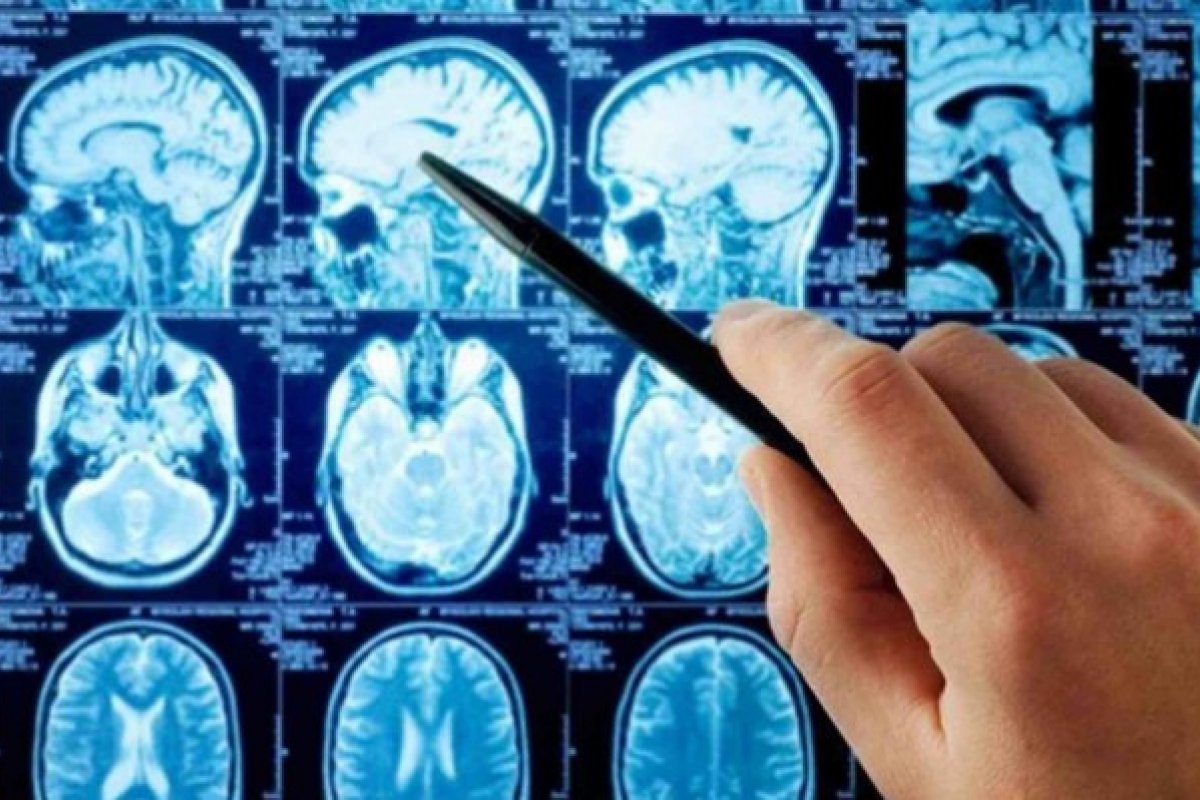 (PARA O FDS) Mudanças climáticas podem ser causadoras de doenças cerebrais, diz estudo