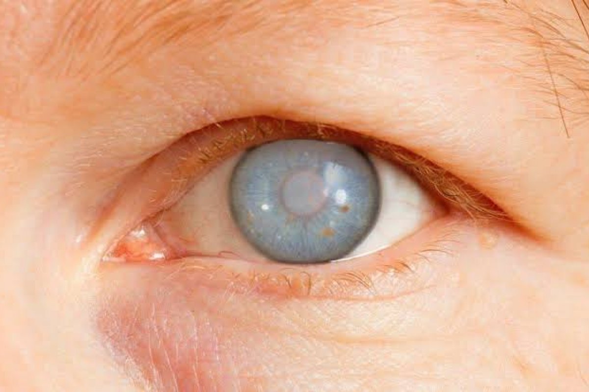 Dia Nacional de Combate ao Glaucoma: doença que não tem cura e se não tratada pode levar à cegueira!