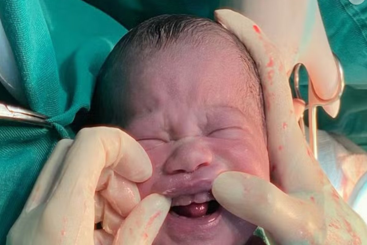 Vídeo: Bebê surpreende equipe médica ao nascer com seis 'dentes' em Campo Grande-MS