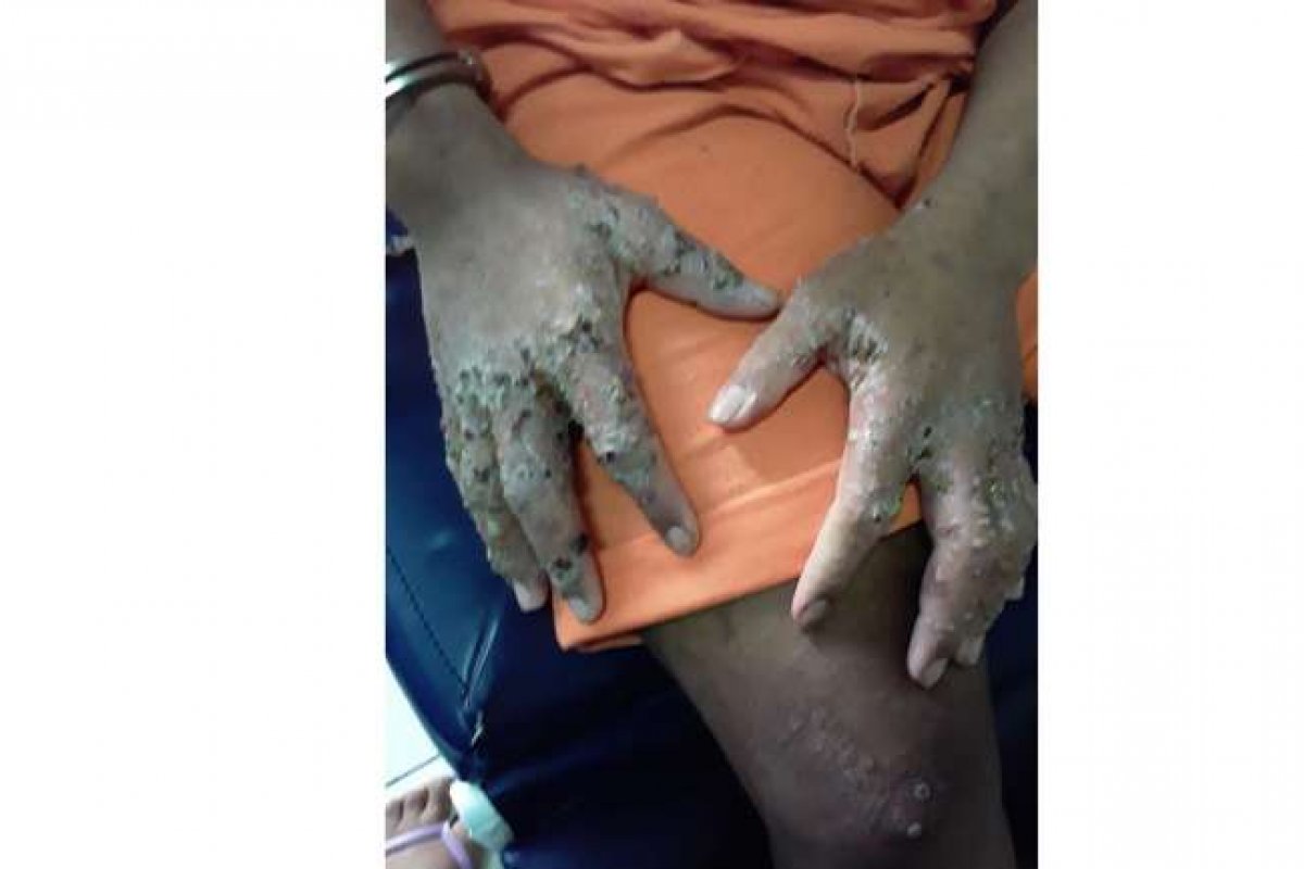 OAB denuncia surto de bactéria em presos de Roraima