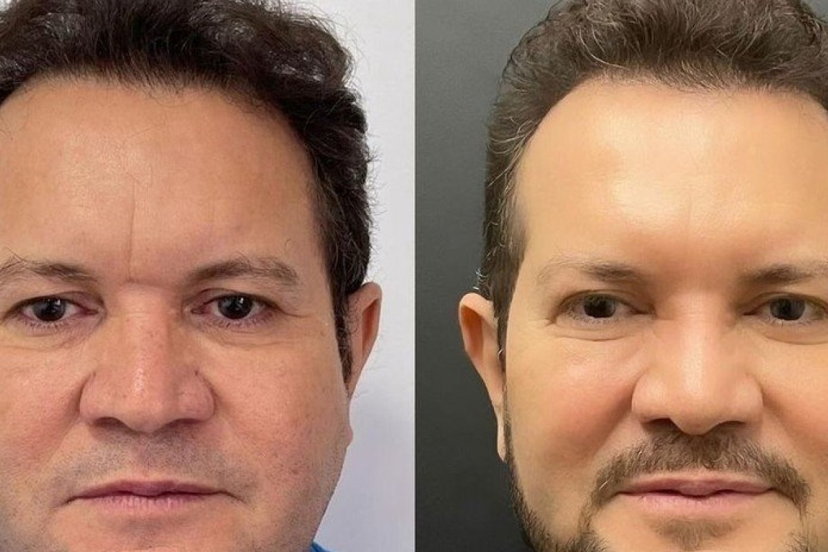 Ximbinha se rende a cirurgia facial. Veja o resultado!