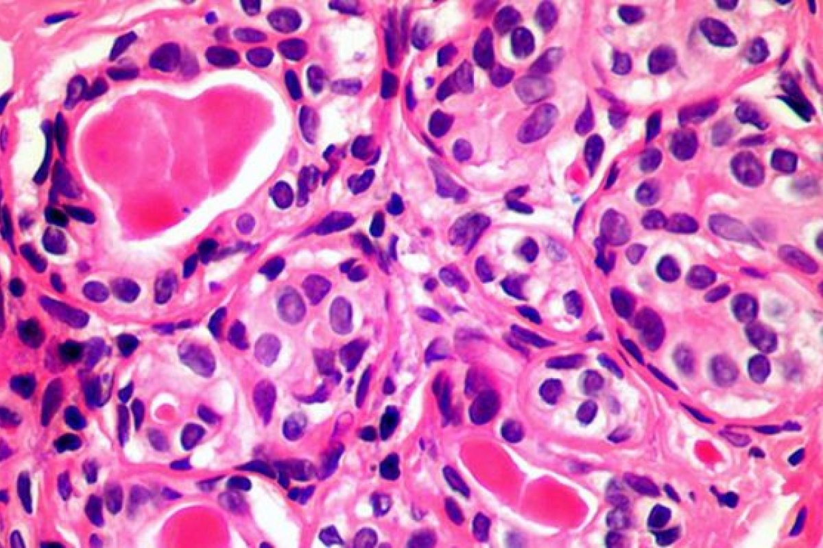 Sistema imunológico pode atacar células cancerosas, aponta estudo