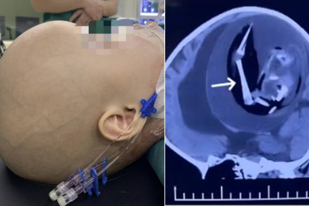 Feto com braços, cabelos e olhos é encontrado dentro do crânio de bebê de 1 ano na China