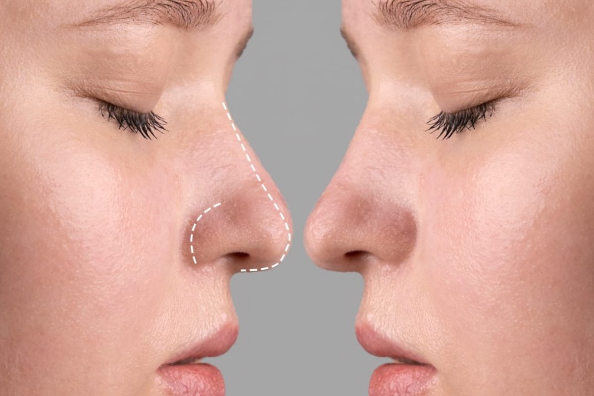 Especialista em rinoplastia explica detalhes do procedimento!