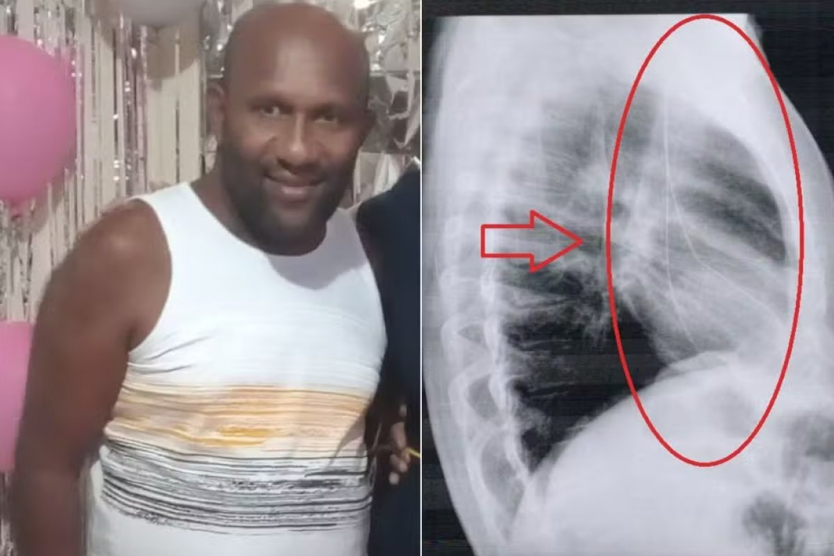 Médico esquece fio-guia entre pescoço e coração de paciente e estado de SP é condenado em R$ 50 mil