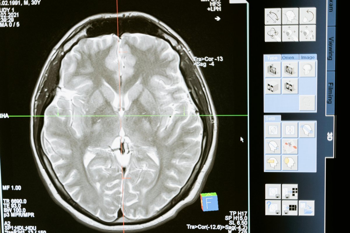 Estudo aponta tratamento promissor no combate a câncer cerebral agressivo e sem cura