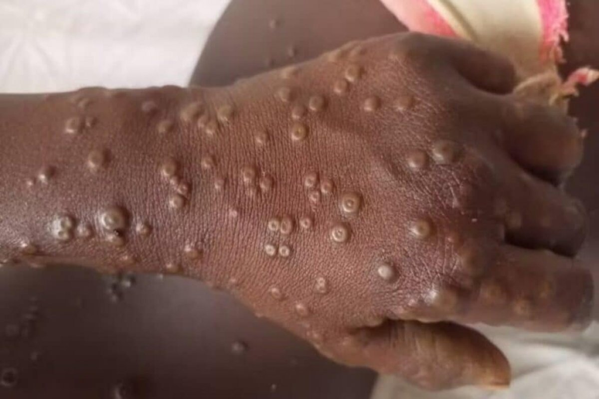 OMS avalia possível retorno de mpox como emergência sanitária global; entenda