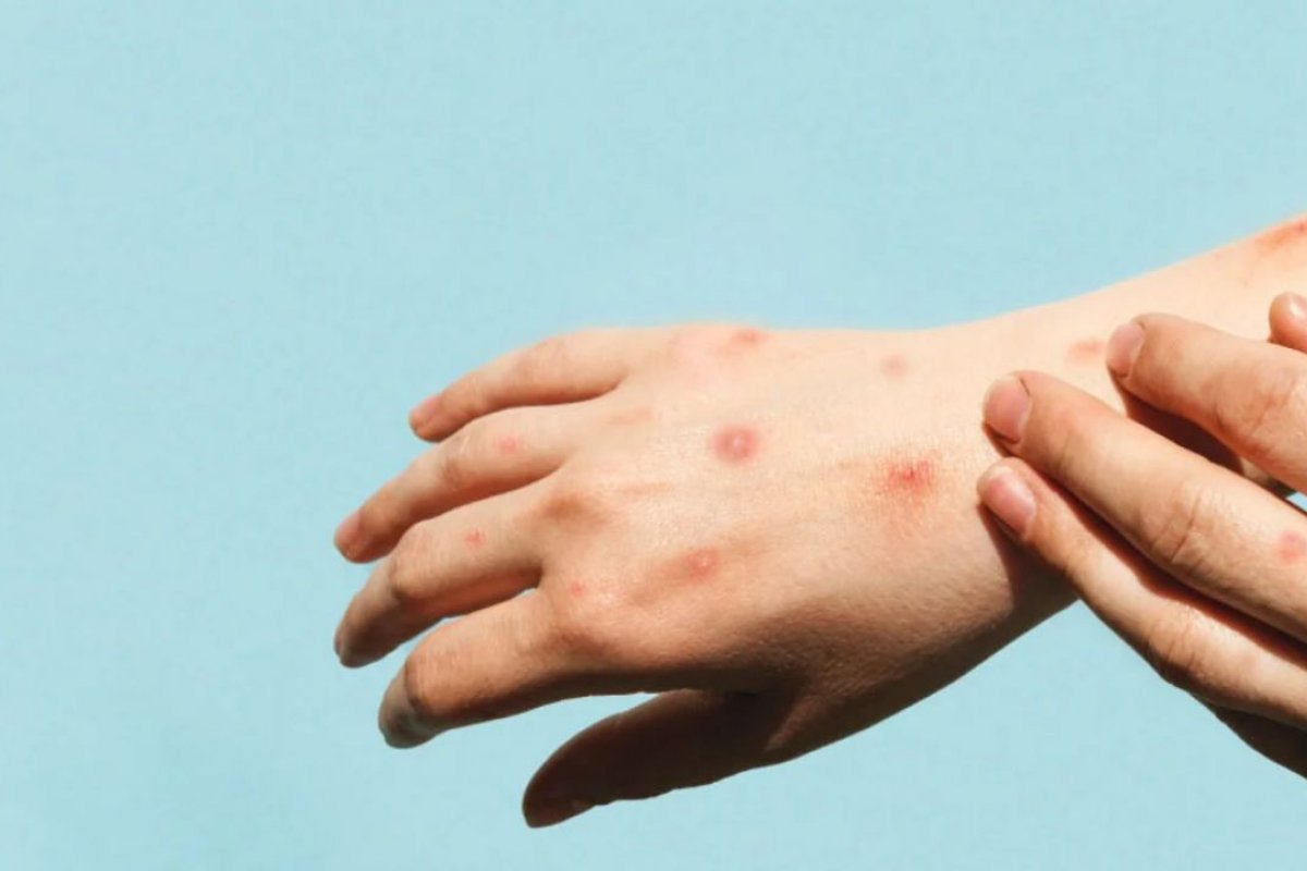 OMS pede a fabricantes que submetam vacinas contra varíola dos macacos para avaliação emergencial