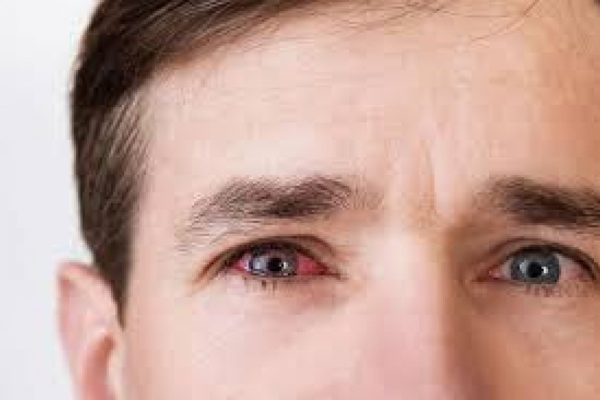 Uso indiscriminado de colírios à base de corticoide aumenta risco de glaucoma!