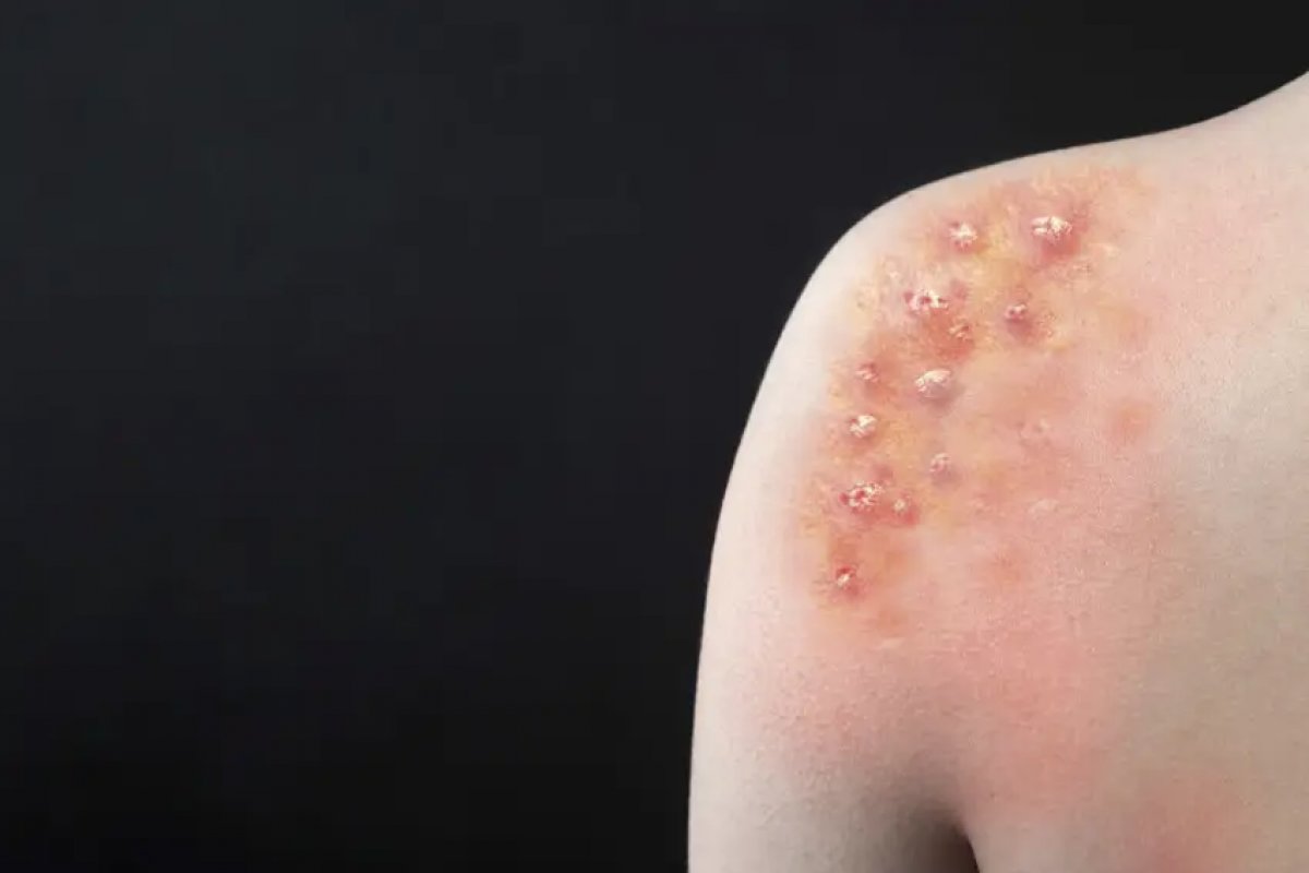 Bahia registra 38 casos de varíola mpox em 2024