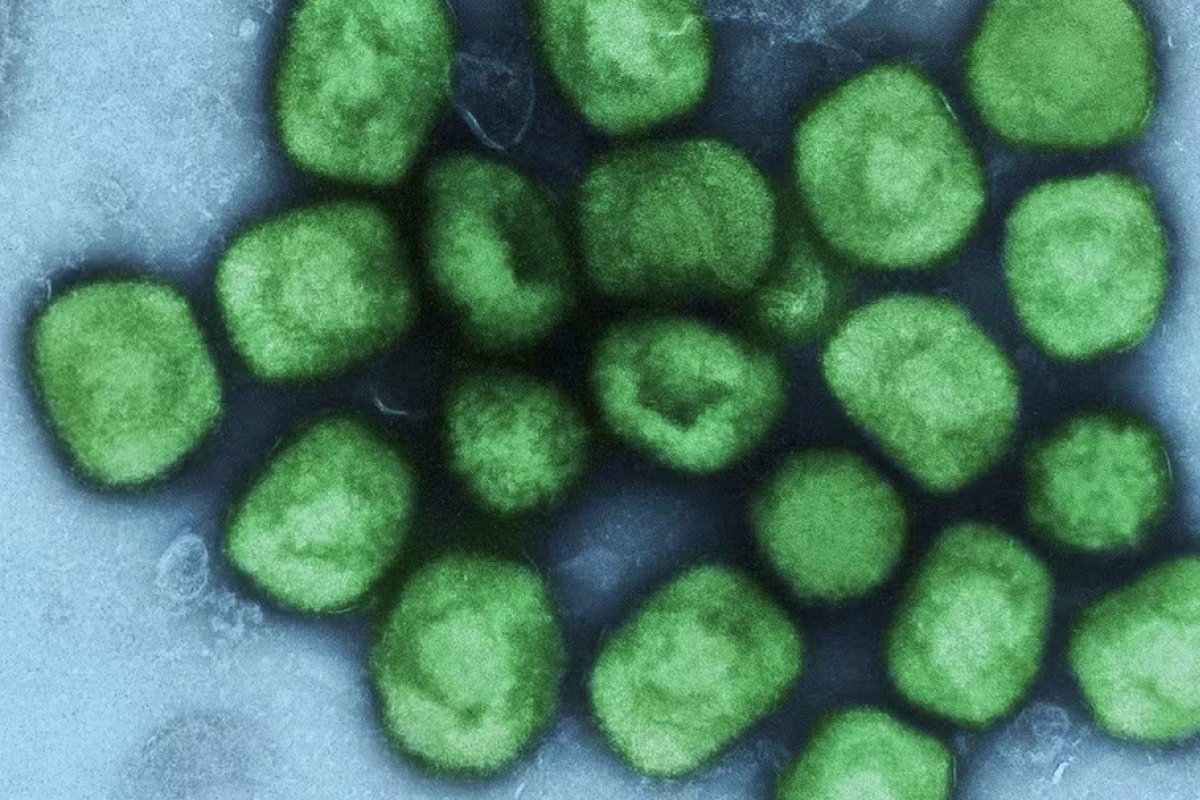 Suécia confirma primeiro caso de Mpox do clado 1b; OMS emitiu alerta máximo para o tipo mais grave da doença